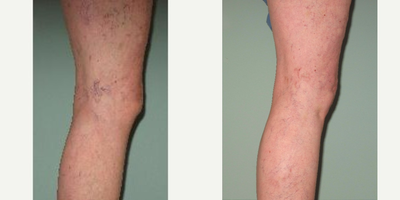 Sclerotherapy before and after photo