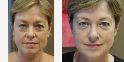 Botox before and after photo