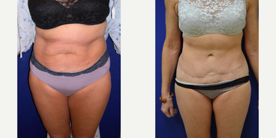 Liposuction before and after photo