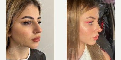 Rhinoplasty before and after photo