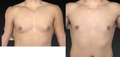 Gynecomastia Surgery before and after photo