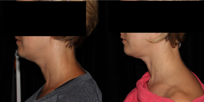 Kybella before and after photo
