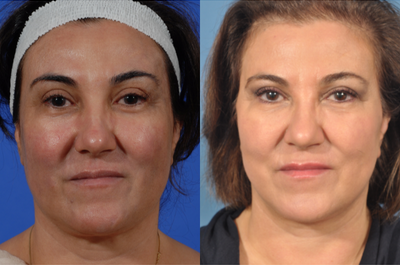 Neck Lift before and after photo