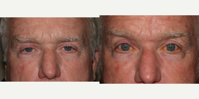 Ptosis Surgery before and after photo