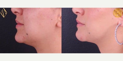 Chin Liposuction before and after photo