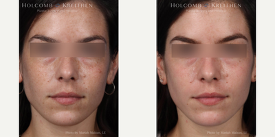 Cosmelan before and after photo