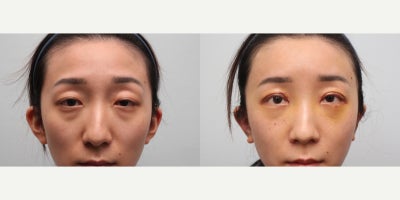 Double Eyelid Surgery before and after photo