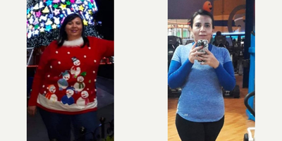 Gastric Bypass before and after photo