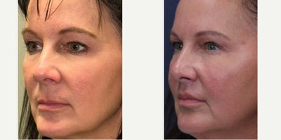 Lip Lift before and after photo
