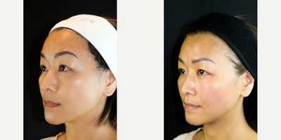 Skin Tightening before and after photo