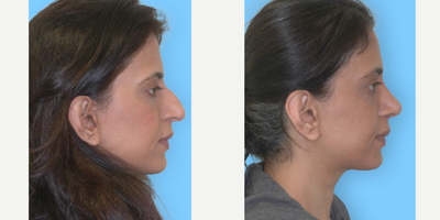 Asian Rhinoplasty before and after photo