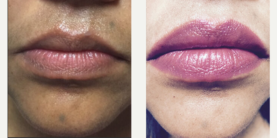 Juvederm before and after photo