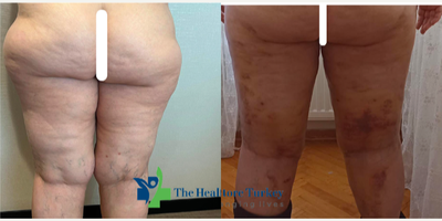 Liposuction before and after photo