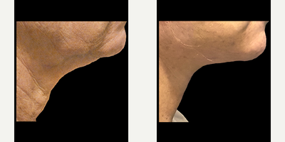 Neck Lift before and after photo