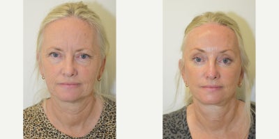 Neck Lift before and after photo