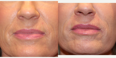 Restylane Silk before and after photo
