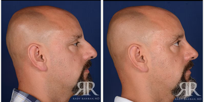 Rhinoplasty before and after photo