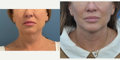Deep Plane Facelift before and after photo