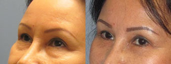 Eyelid Surgery before and after photo