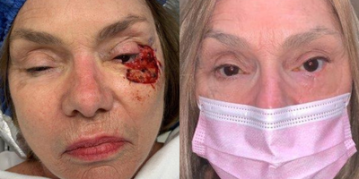 Facial Reconstructive Surgery before and after photo