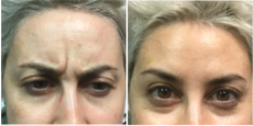 Botox before and after photo