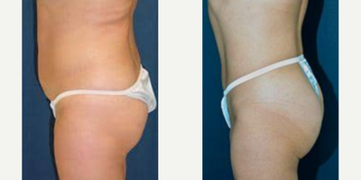 Butt Augmentation before and after photo