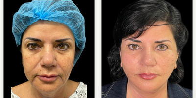 Eyelid Surgery before and after photo