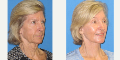 Facelift before and after photo