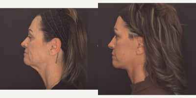 Facelift before and after photo