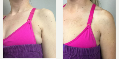 Kybella before and after photo