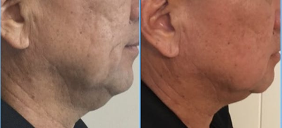 Kybella before and after photo