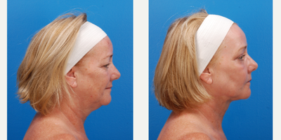 Laser Liposuction before and after photo
