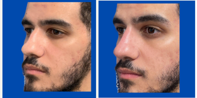 Restylane before and after photo