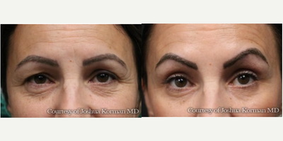 Eyelid Surgery before and after photo
