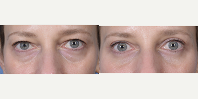 Eyelid Surgery before and after photo