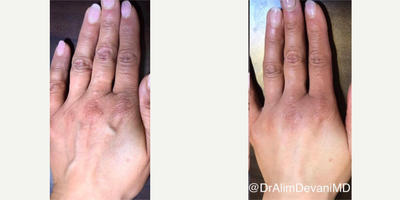 Hand Rejuvenation before and after photo