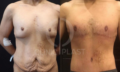 Body Lift before and after photo