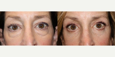 Eyelid Surgery before and after photo