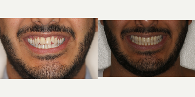Invisalign before and after photo