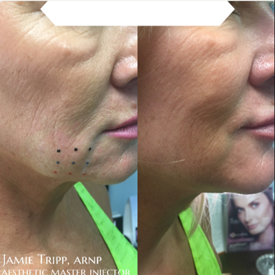 Kybella before and after photo