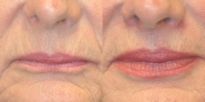 Lip Lift before and after photo