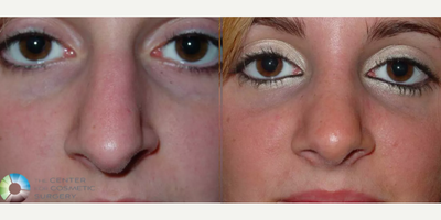 Rhinoplasty before and after photo
