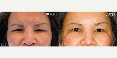 Brow Lift before and after photo