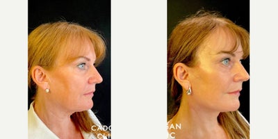 Deep Plane Facelift before and after photo
