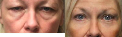 Laser Resurfacing before and after photo