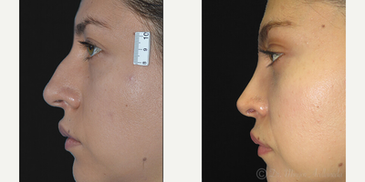 Rhinoplasty before and after photo