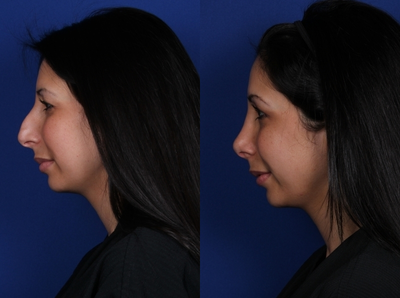 Rhinoplasty before and after photo
