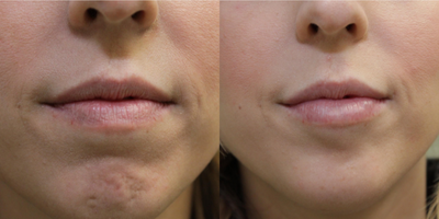 Botox before and after photo
