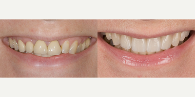 Dental Crown before and after photo