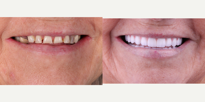 Dental Implants before and after photo